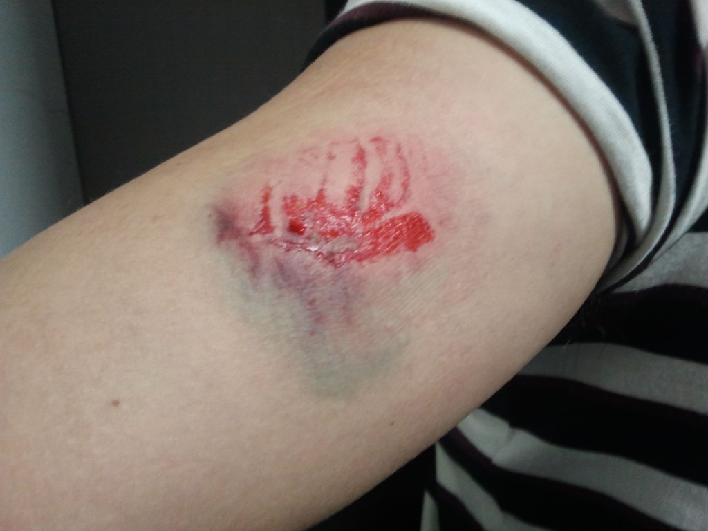O braço direito do chefe de gabinete da Prefeitura de Arco-Iris, Everton Nakashima ficou ferido com a mordida