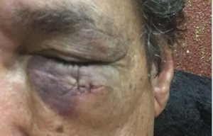 Advogado Milton Walsinir de Lima, 60 anos, o Dr. Barata, teve o olho lesionado em cabeçada (Foto: Hojemais Araçatuba)